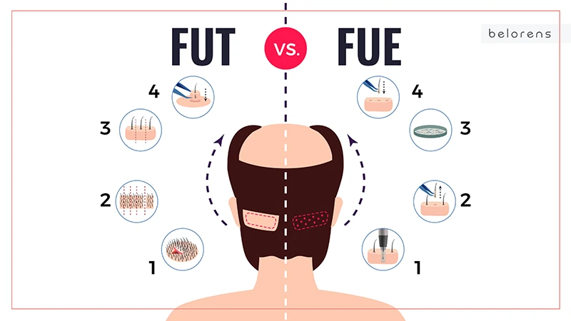 Comparison between the FUT strip method and the FUE method