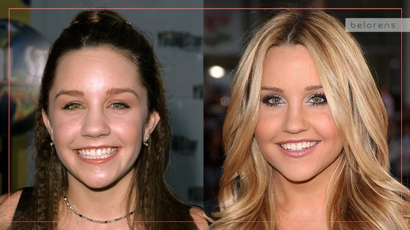 ​Amanda Bynes Before and After Nose job