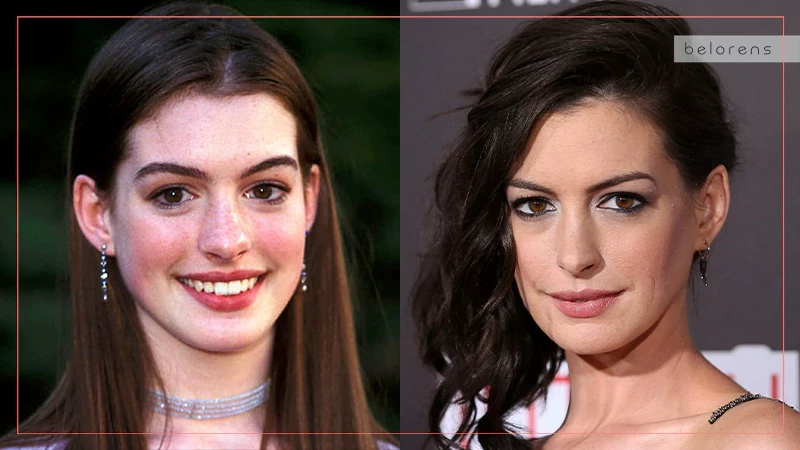 Anne Hathaway Before and After Nose Surgery