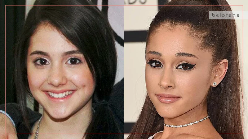 Ariana Grande Before and After Rhinoplasty