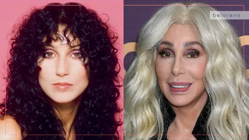 ​Cher Before and After Rhinoplasty