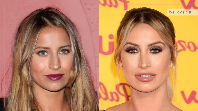 Ferne McCann Before and After Nose Surgery