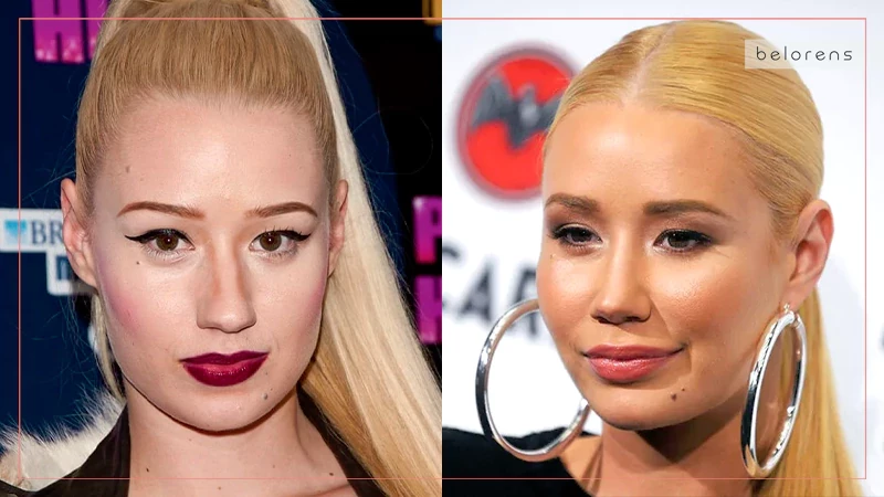 Iggy Azalea Before and After Nose Surgery