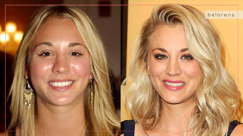 Kaley Cuoco Before and After Nose Surgery