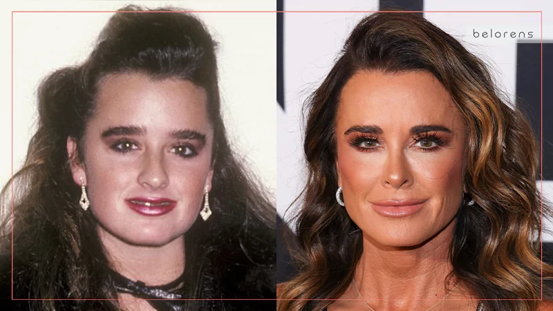 ​Kyle Richards Before and After Rhinoplasty