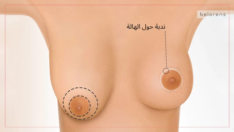 Periareolar Incision