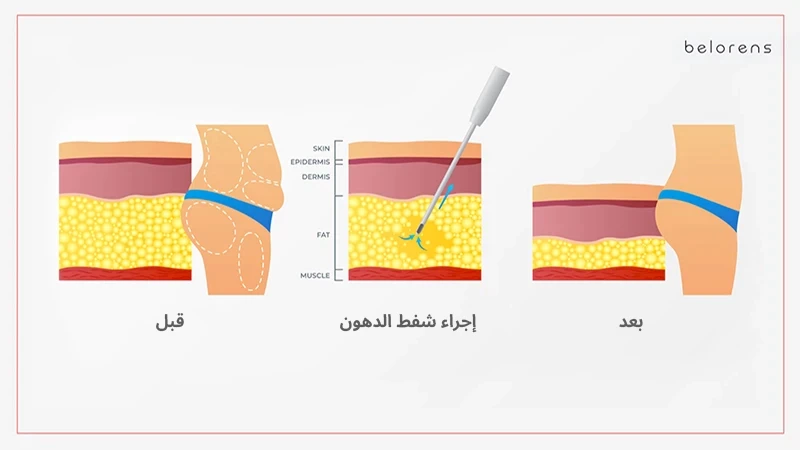 • Liposuction