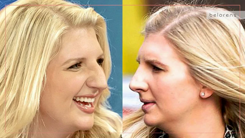Rebecca Adlington Before and After Nose job