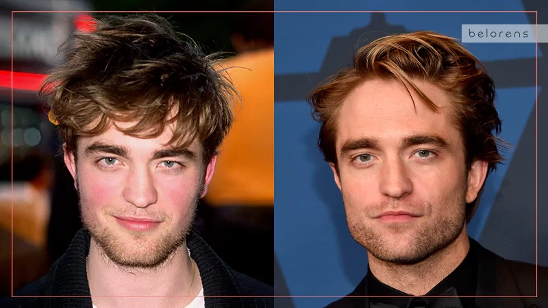 Robert Pattinson Before and After Nose job