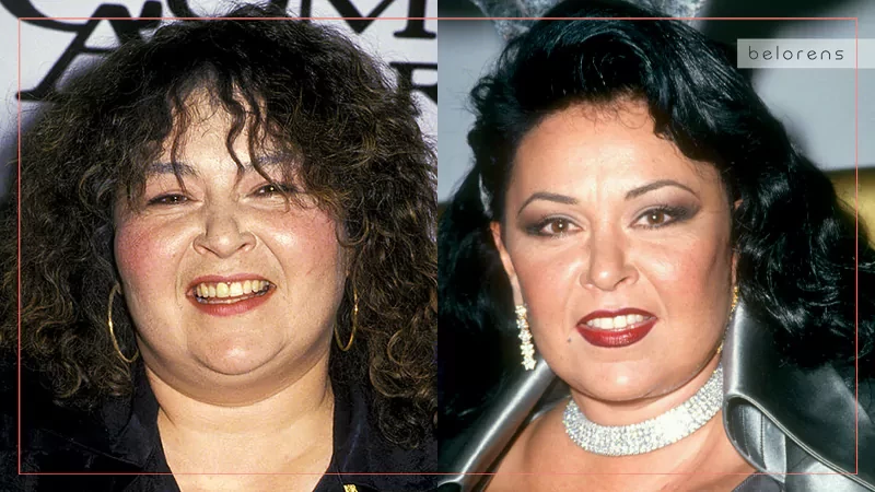 ​Roseanne Barr Before and After Nose Reshaping