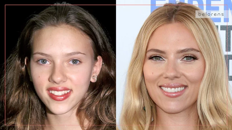 Scarlett Johansson Nose Job Before and After Photo