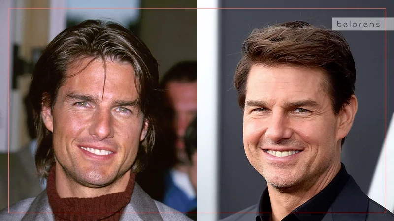 Tom Cruise Before and After Nose job