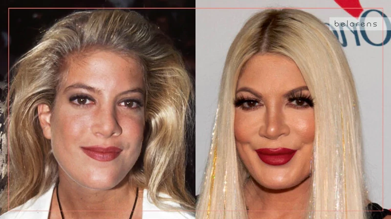 Tori Spelling Before and After Rhinoplasty