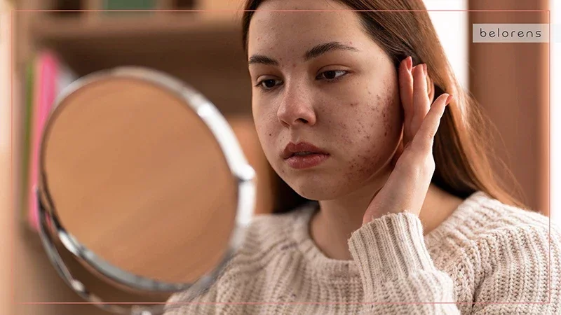 Severe Acne: Deep-Rooted Concerns