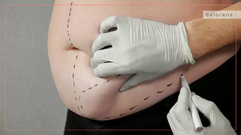 extended-or-circumferential-abdominoplasty-scar