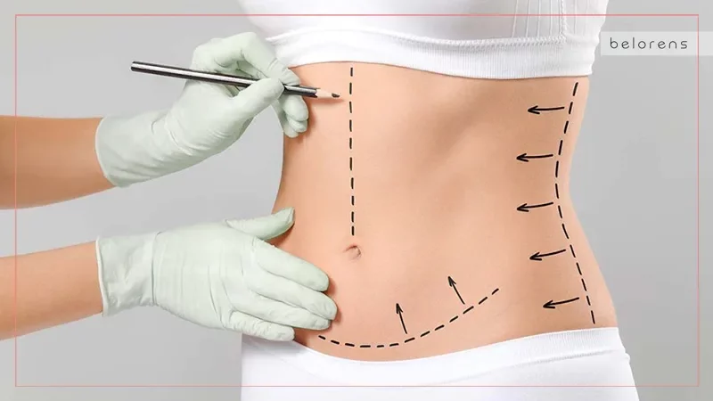 fleur-de-lis-or-vertical-abdominoplasty-scar