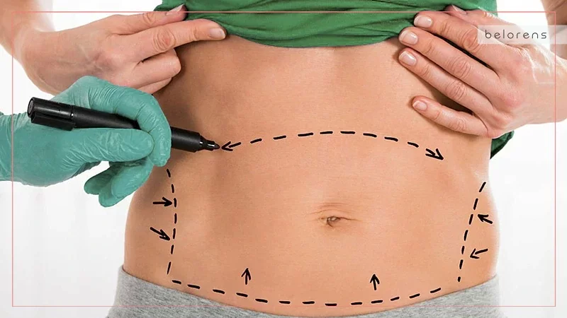 traditional-or-full-abdominoplasty-scar
