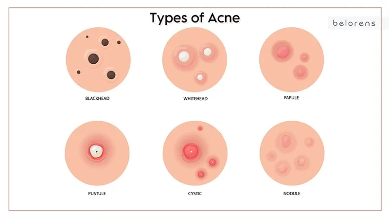 types-of-acne