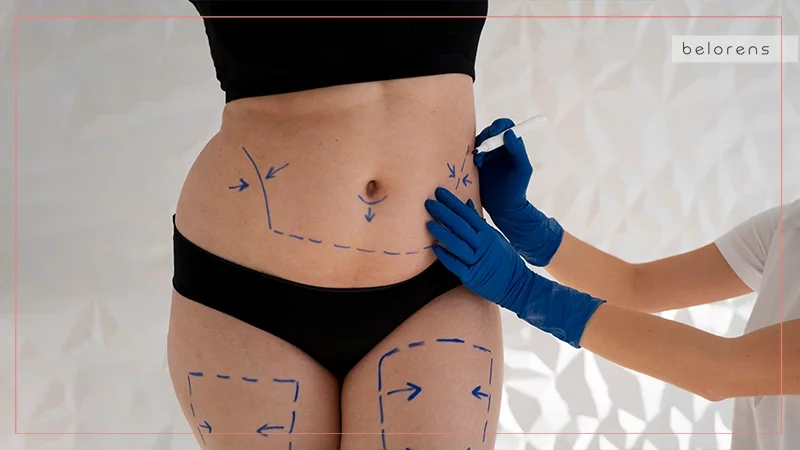Abdominoplasty (Tummy Tuck)