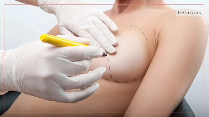 Combining breast lift with fat transfer augmentation