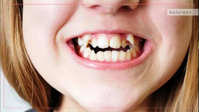 Crooked teeth - Japan