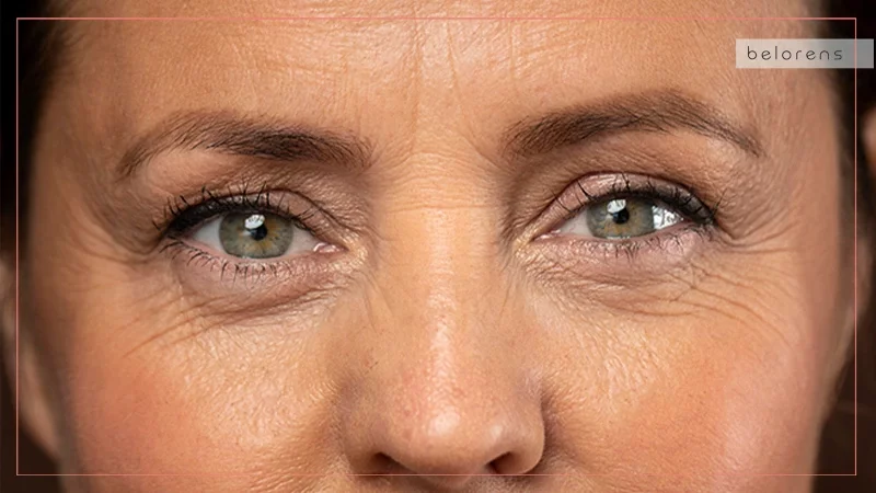 أسباب التجاعيد