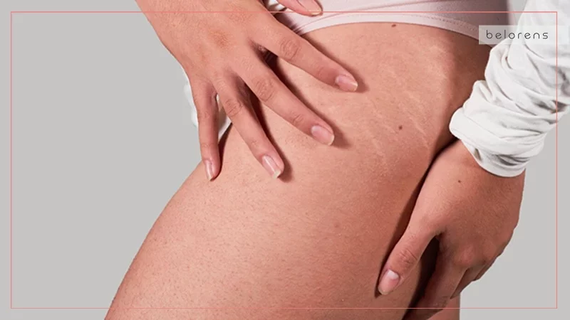 3Not good for stretch marks and cellulite