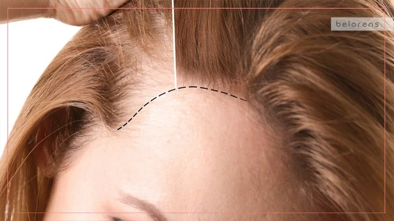 Hairline lowering with scalp advancement vs hair transplant