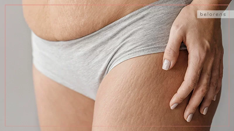 Myth 3 Liposuction can treat cellulite