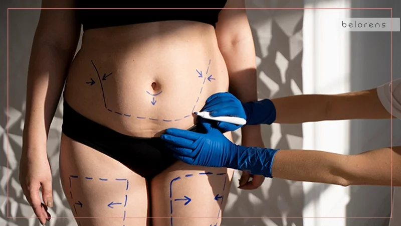 Should I have a tummy tuck or liposuction after pregnancy