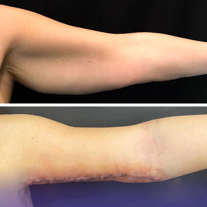 before & after photo of Arm Lift