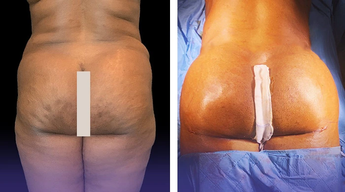 before & after photo of Brazilian Butt Lift