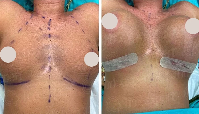 before & after photo of breast-implants