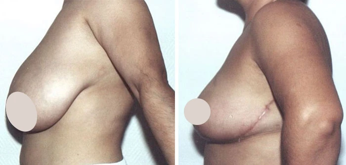 before & after photo of Breast Reduction