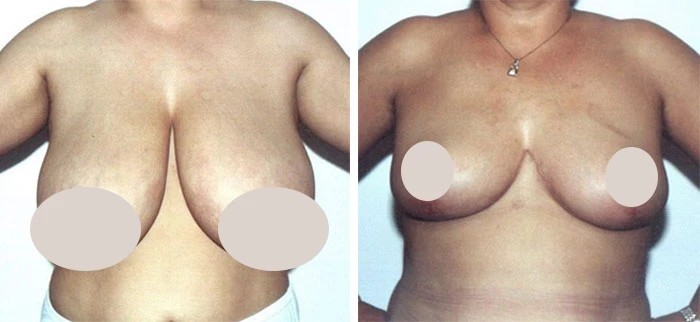 before & after photo of Breast Reduction