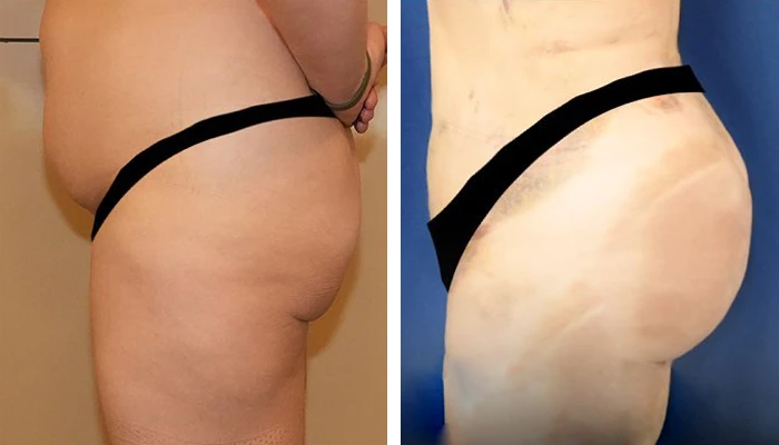 before & after photo of butt-lift