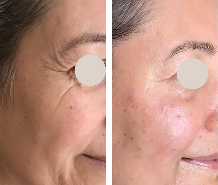 before & after photo of Cheek Filler