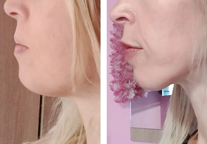 before & after photo of Rhinoplasty