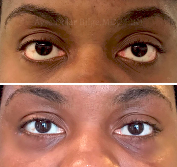 before & after photo of Eyelid Retraction Surgery