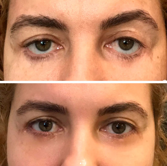 before & after photo of eyelid-retraction-surgery