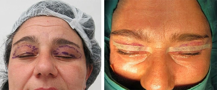 before & after photo of عملية تجميل الجفون