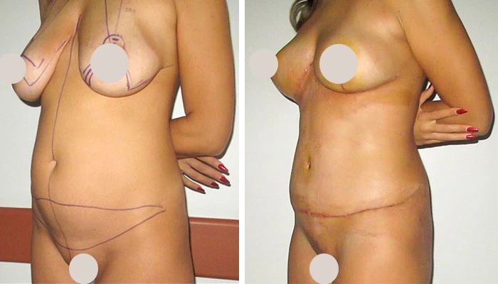 before & after photo of Tummy Tuck