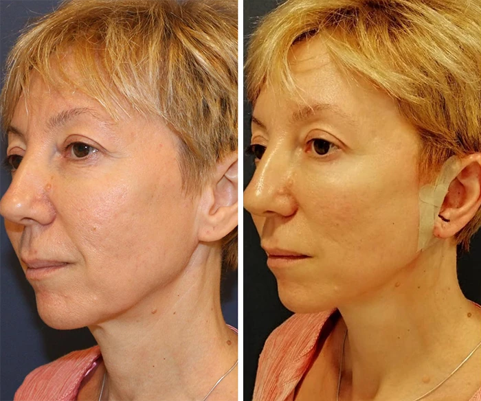 before & after photo of Rhinoplasty