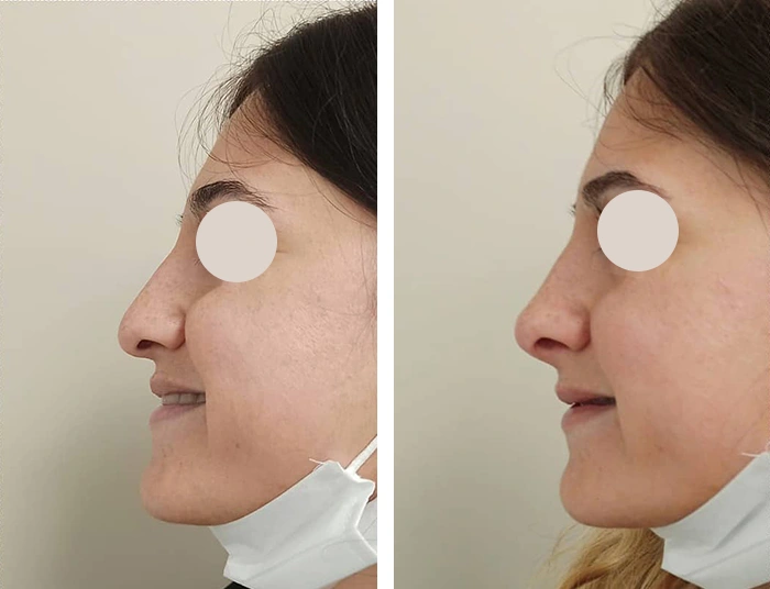 before & after photo of nose-filler
