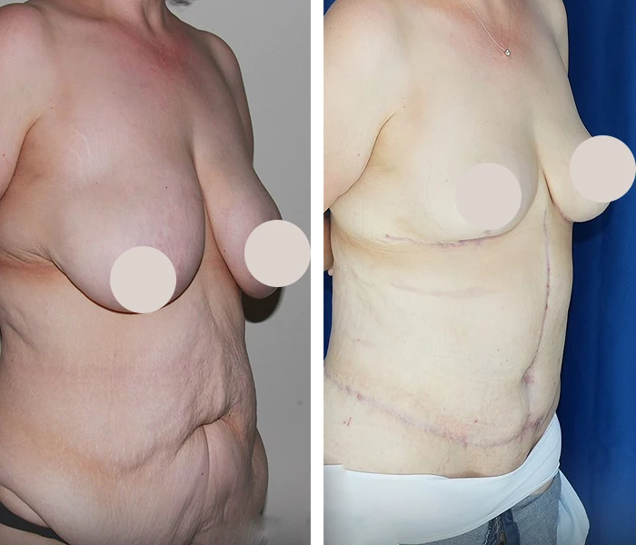 before & after photo of Tummy Tuck