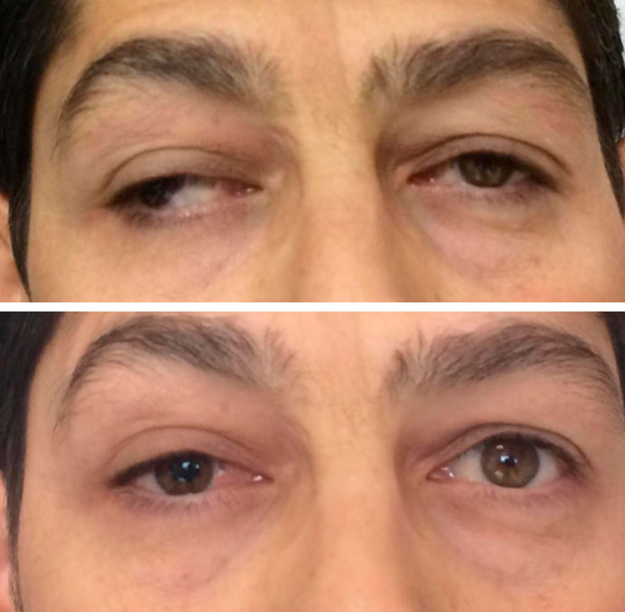 before & after photo of Strabismus Surgery