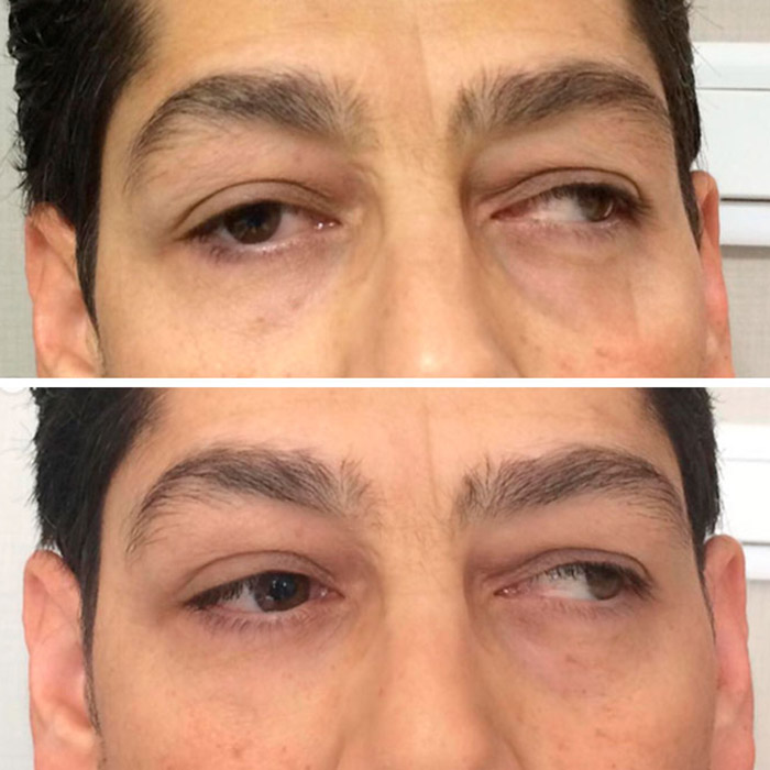 Strabismus Surgery Before And After Photos