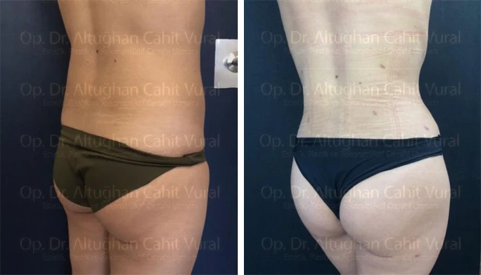before & after photo of tummy-tuck
