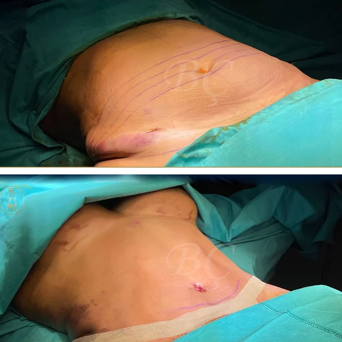 before & after photo of Tummy Tuck