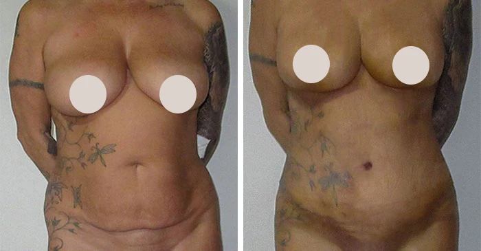before & after photo of tummy-tuck